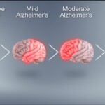 Alzeimer's Diseases