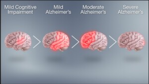 Alzeimer's Diseases