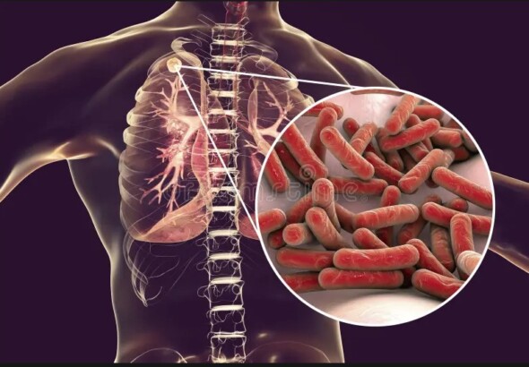 TUBERCULOSIS-2
